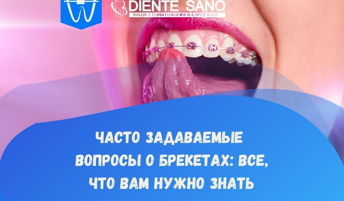 Часто задаваемые вопросы о брекетах: все, что вам нужно знать