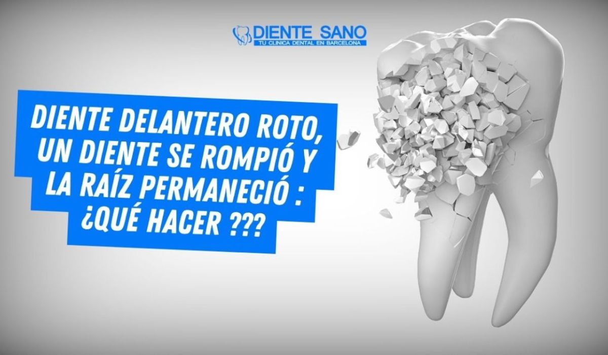Diente frontal roto, se ha roto un diente y queda la raíz: ¿qué hacer?