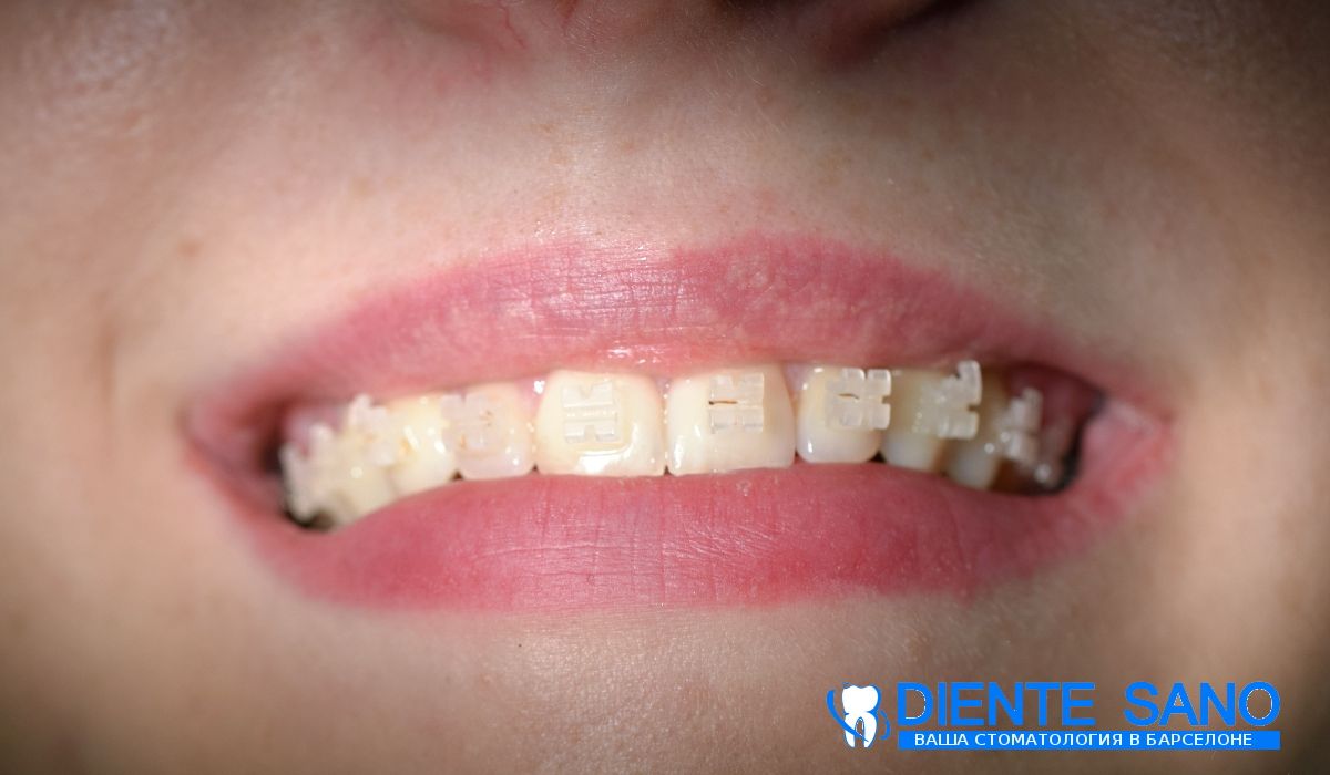 Orthodontics in Barcelona Orthodontics in Barcelona