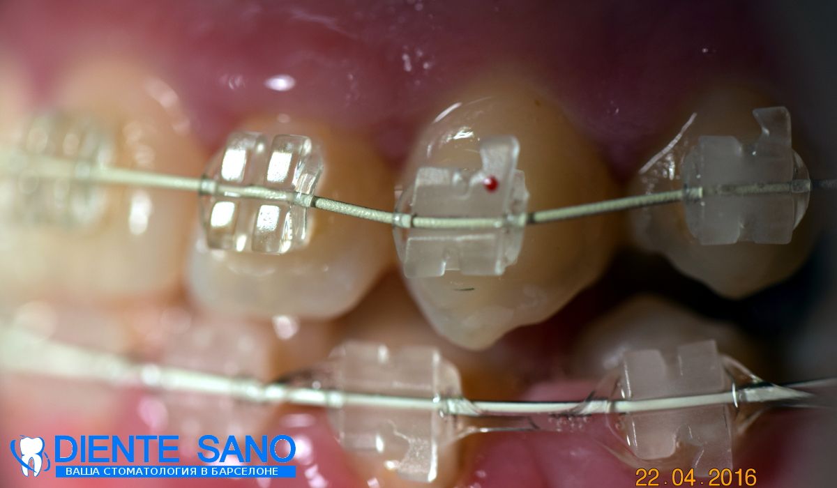 Orthodontics in Barcelona