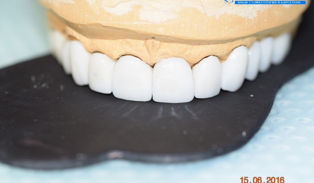 Reabilitación dental en Barcelona Reabilitación dental en Barcelona