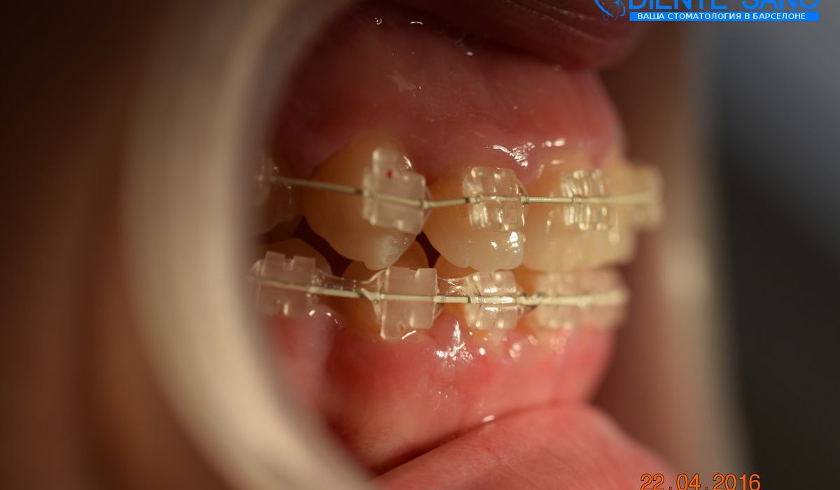 Orthodontics in Barcelona