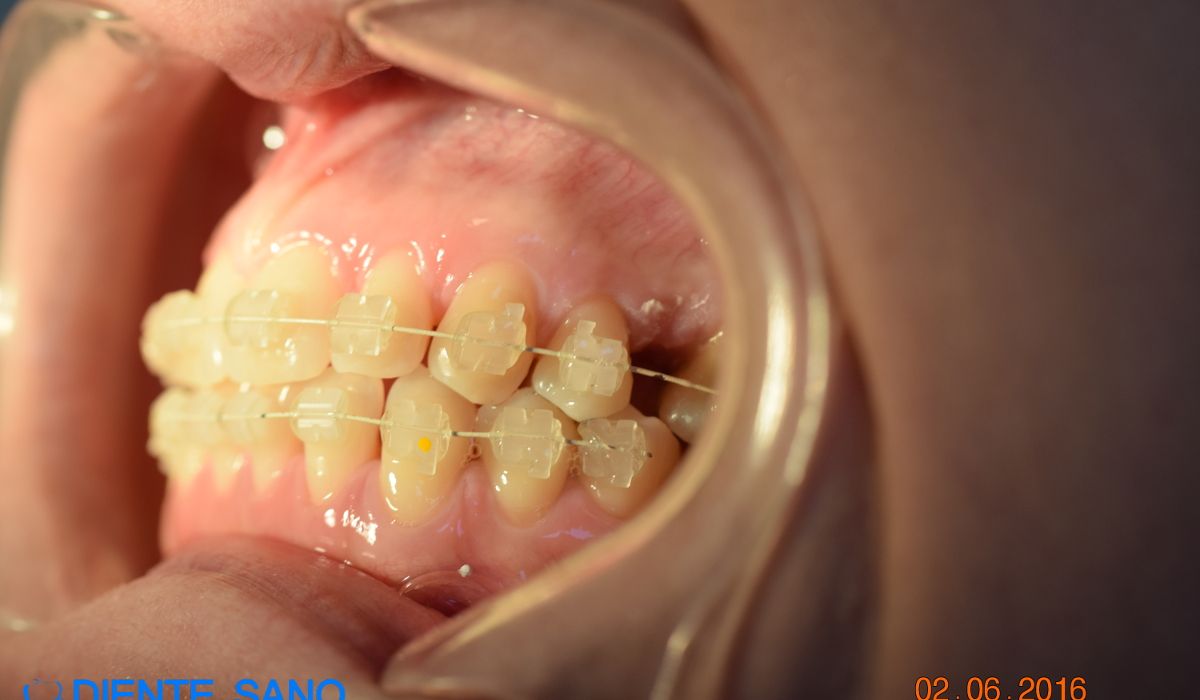 Брекеты в Барселоне, Стоматологическая клиника Diente Sano в Барселоне