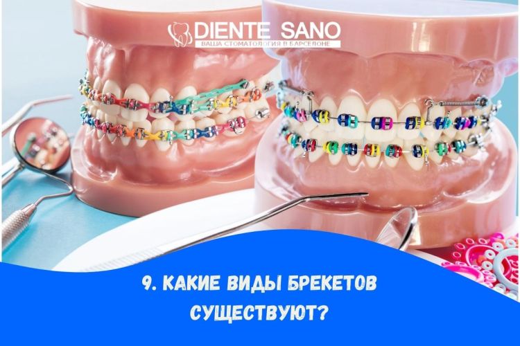 Часто задаваемые вопросы о брекетах: все, что вам нужно знать. Какие виды брекетов существуют?