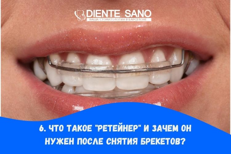 Часто задаваемые вопросы о брекетах: все, что вам нужно знать. Что такое "ретейнер" и зачем он нужен после снятия брекетов?