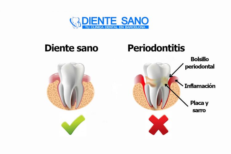 ¿Es correcto que a mayor edad aumenta el riesgo de enfermedad periodontal?